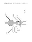 WOVEN VASCULAR DEVICE END TREATMENTS diagram and image