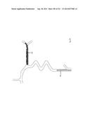 WOVEN VASCULAR DEVICE END TREATMENTS diagram and image