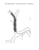 WOVEN VASCULAR DEVICE END TREATMENTS diagram and image