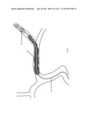 WOVEN VASCULAR DEVICE END TREATMENTS diagram and image