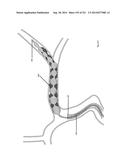 WOVEN VASCULAR DEVICE END TREATMENTS diagram and image