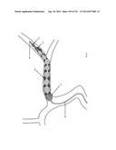 WOVEN VASCULAR DEVICE END TREATMENTS diagram and image