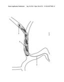 WOVEN VASCULAR DEVICE END TREATMENTS diagram and image