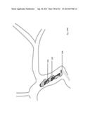 WOVEN VASCULAR DEVICE END TREATMENTS diagram and image