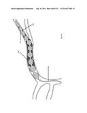 WOVEN VASCULAR DEVICE END TREATMENTS diagram and image