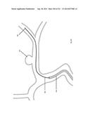 WOVEN VASCULAR DEVICE END TREATMENTS diagram and image