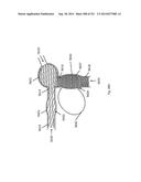 WOVEN VASCULAR DEVICE END TREATMENTS diagram and image