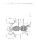 WOVEN VASCULAR DEVICE END TREATMENTS diagram and image