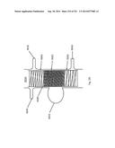 WOVEN VASCULAR DEVICE END TREATMENTS diagram and image