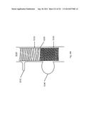 WOVEN VASCULAR DEVICE END TREATMENTS diagram and image