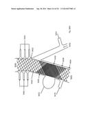 WOVEN VASCULAR DEVICE END TREATMENTS diagram and image