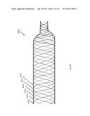 WOVEN VASCULAR DEVICE END TREATMENTS diagram and image