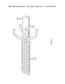 WOVEN VASCULAR DEVICE END TREATMENTS diagram and image