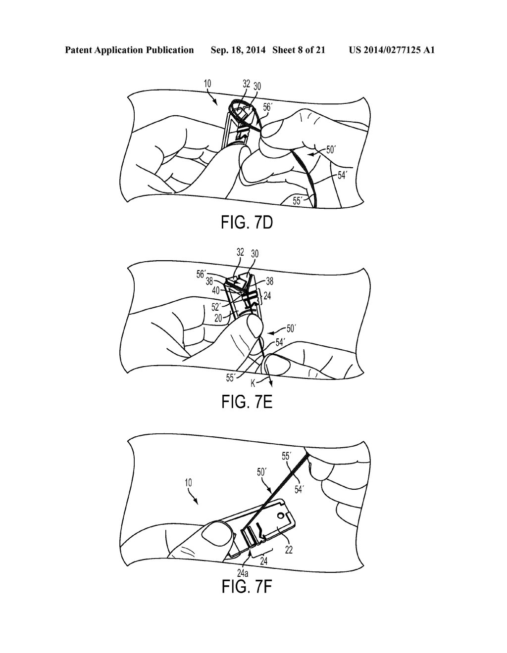 SUTURE STORAGE DEVICES, SYSTEMS, AND METHODS - diagram, schematic, and image 09