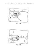 SUTURE STORAGE DEVICES, SYSTEMS, AND METHODS diagram and image