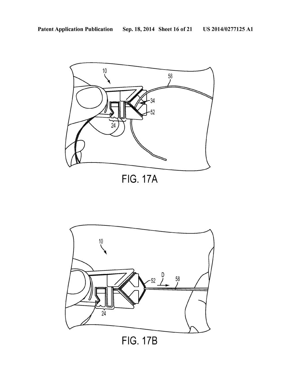 SUTURE STORAGE DEVICES, SYSTEMS, AND METHODS - diagram, schematic, and image 17