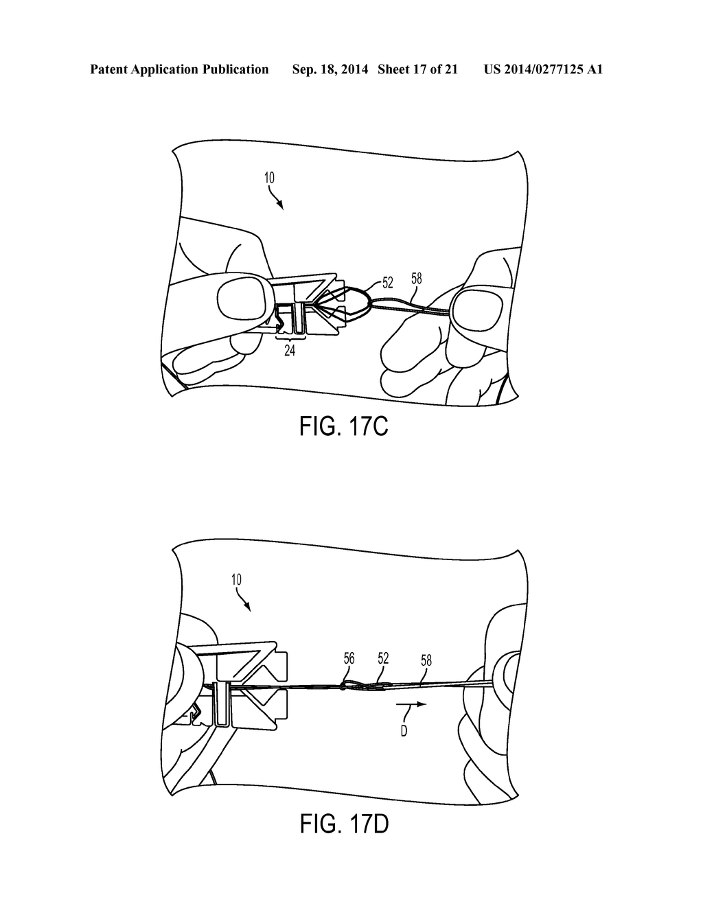 SUTURE STORAGE DEVICES, SYSTEMS, AND METHODS - diagram, schematic, and image 18