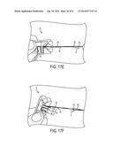 SUTURE STORAGE DEVICES, SYSTEMS, AND METHODS diagram and image