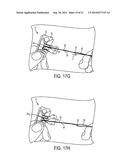 SUTURE STORAGE DEVICES, SYSTEMS, AND METHODS diagram and image