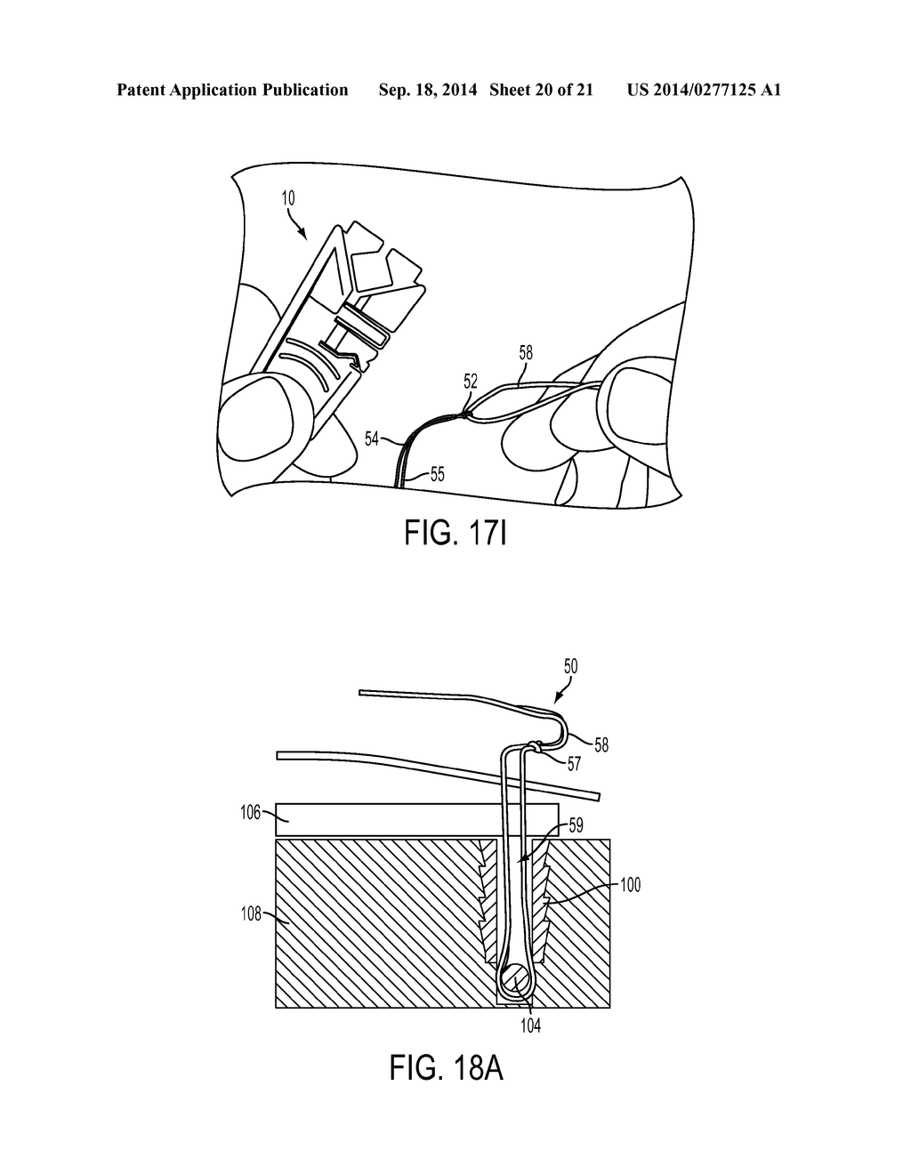 SUTURE STORAGE DEVICES, SYSTEMS, AND METHODS - diagram, schematic, and image 21