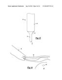 KNOTLESS GRAFT FIXATION ASSEMBLY diagram and image