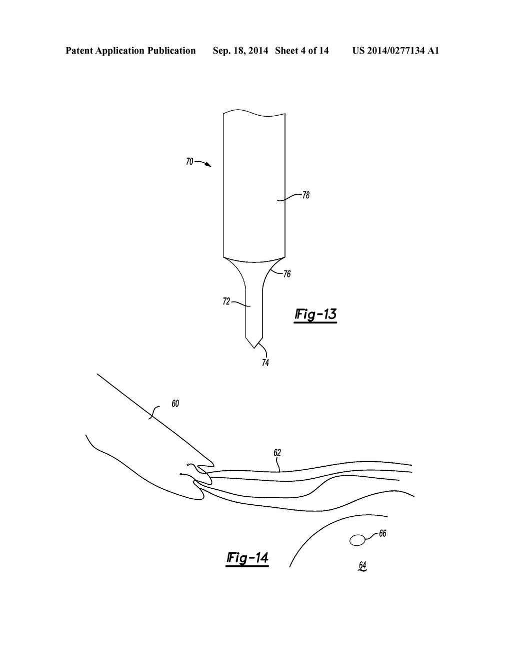 KNOTLESS GRAFT FIXATION ASSEMBLY - diagram, schematic, and image 05