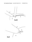 KNOTLESS GRAFT FIXATION ASSEMBLY diagram and image