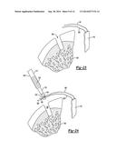 KNOTLESS GRAFT FIXATION ASSEMBLY diagram and image