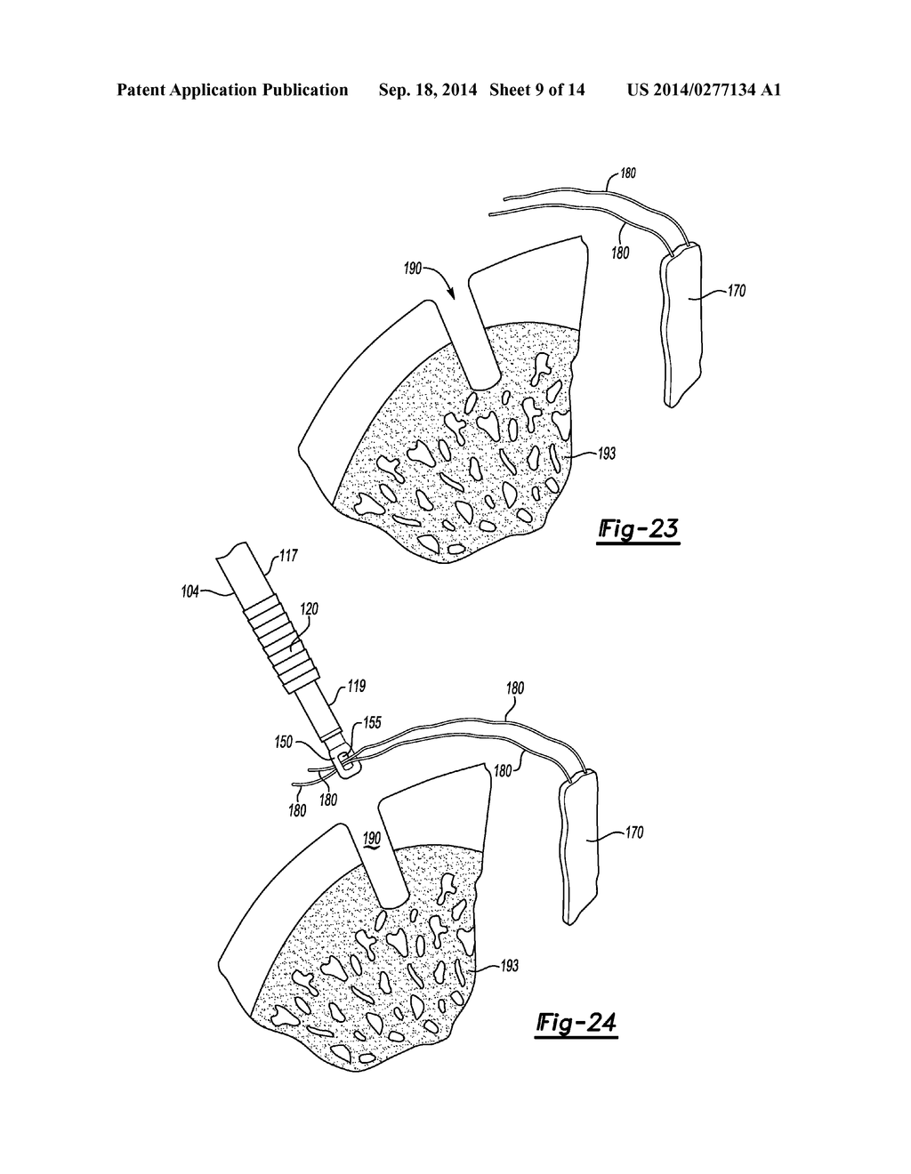 KNOTLESS GRAFT FIXATION ASSEMBLY - diagram, schematic, and image 10