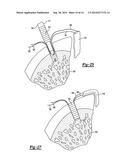 KNOTLESS GRAFT FIXATION ASSEMBLY diagram and image