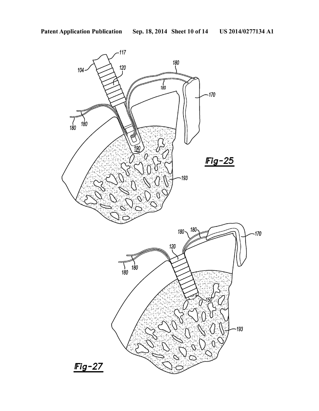 KNOTLESS GRAFT FIXATION ASSEMBLY - diagram, schematic, and image 11