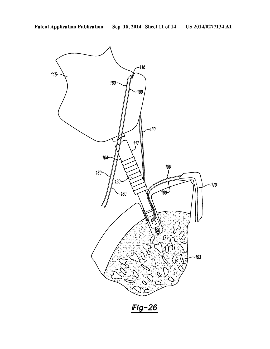 KNOTLESS GRAFT FIXATION ASSEMBLY - diagram, schematic, and image 12
