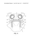 Posterior Ankle Fusion Plate diagram and image