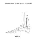 Posterior Ankle Fusion Plate diagram and image