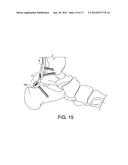 Posterior Ankle Fusion Plate diagram and image