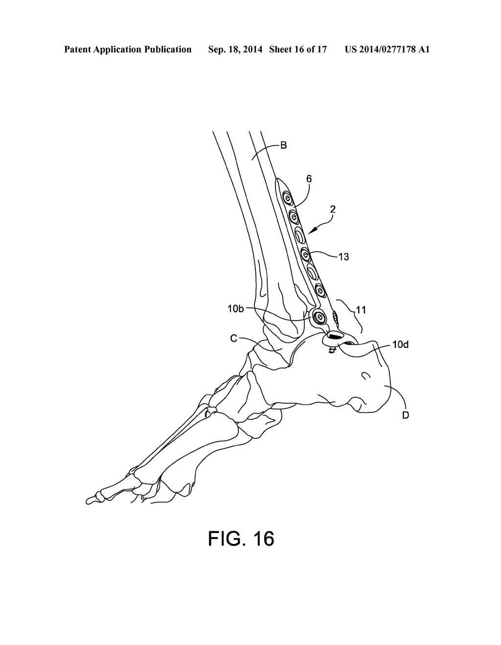 Posterior Ankle Fusion Plate - diagram, schematic, and image 17