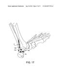 Posterior Ankle Fusion Plate diagram and image