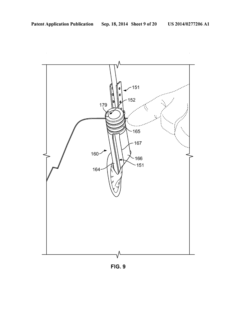 SYSTEMS AND METHODS FOR PERCUTANEOUS SPINAL FUSION - diagram, schematic, and image 10