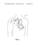 IMPLANTABLE MEDICAL DEVICE INCLUDING A MOLDED PLANAR TRANSFORMER diagram and image