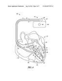 ESTIMATING ELECTROMECHANICAL DELAY TO OPTIMIZE PACING PARAMETERS IN RBBB     PATIENTS diagram and image