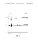 ESTIMATING ELECTROMECHANICAL DELAY TO OPTIMIZE PACING PARAMETERS IN RBBB     PATIENTS diagram and image