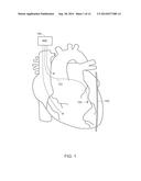 PHRENIC NERVE STIMULATION DETECTION WITH POSTURE SENSING diagram and image