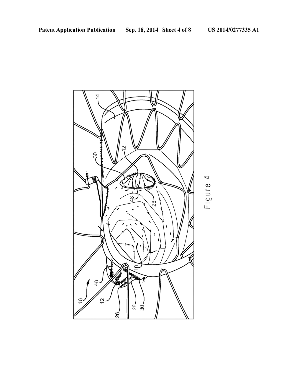 PROSTHESIS HAVING AN EVERTING PIVOTING FENESTRATION - diagram, schematic, and image 05