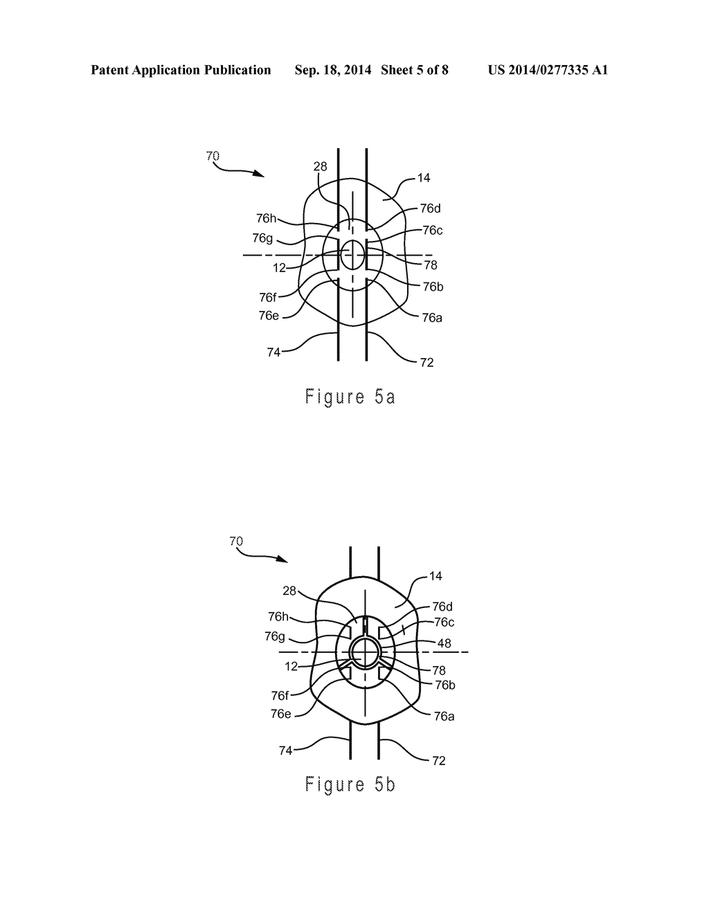 PROSTHESIS HAVING AN EVERTING PIVOTING FENESTRATION - diagram, schematic, and image 06