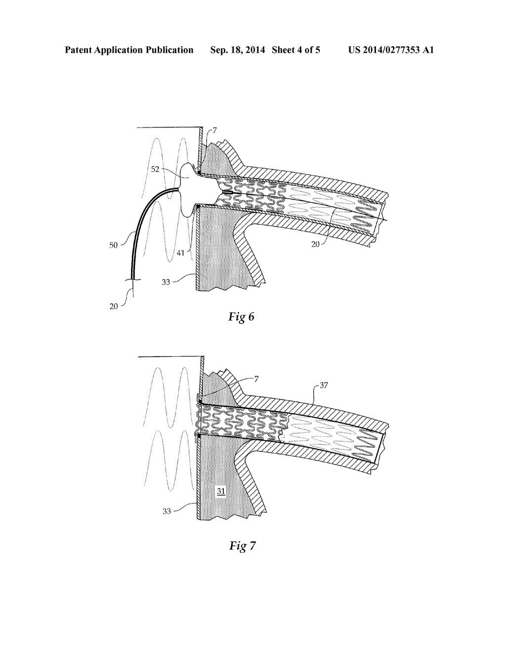 COMPOSITE STENT GRAFT - diagram, schematic, and image 05