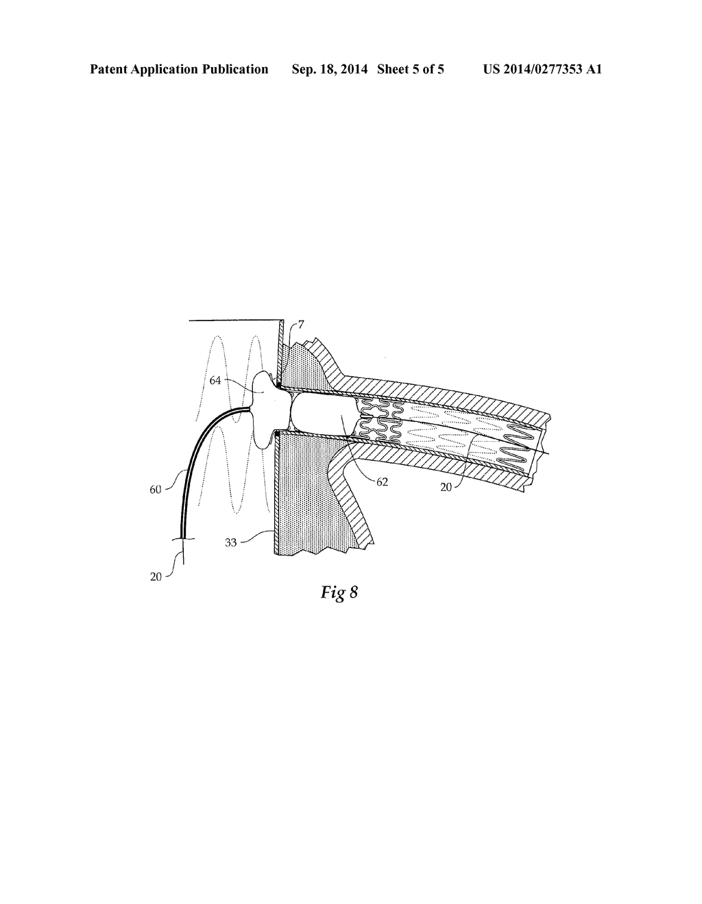 COMPOSITE STENT GRAFT - diagram, schematic, and image 06