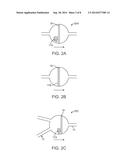 METHOD FOR FORMING MATERIALS IN SITU WITHIN A MEDICAL DEVICE diagram and image