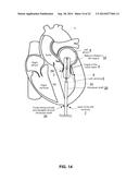 TRANS-APICAL IMPLANT SYSTEMS, IMPLANTS AND METHODS diagram and image