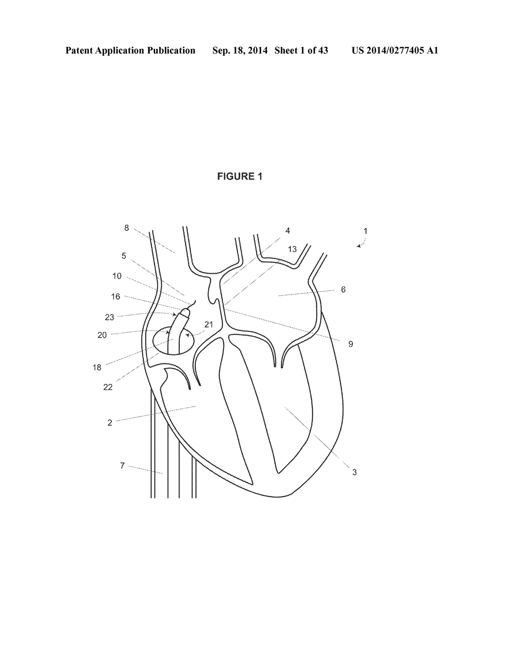 MITRAL VALVE SPACER AND SYSTEM AND METHOD FOR IMPLANTING THE SAME - diagram, schematic, and image 02