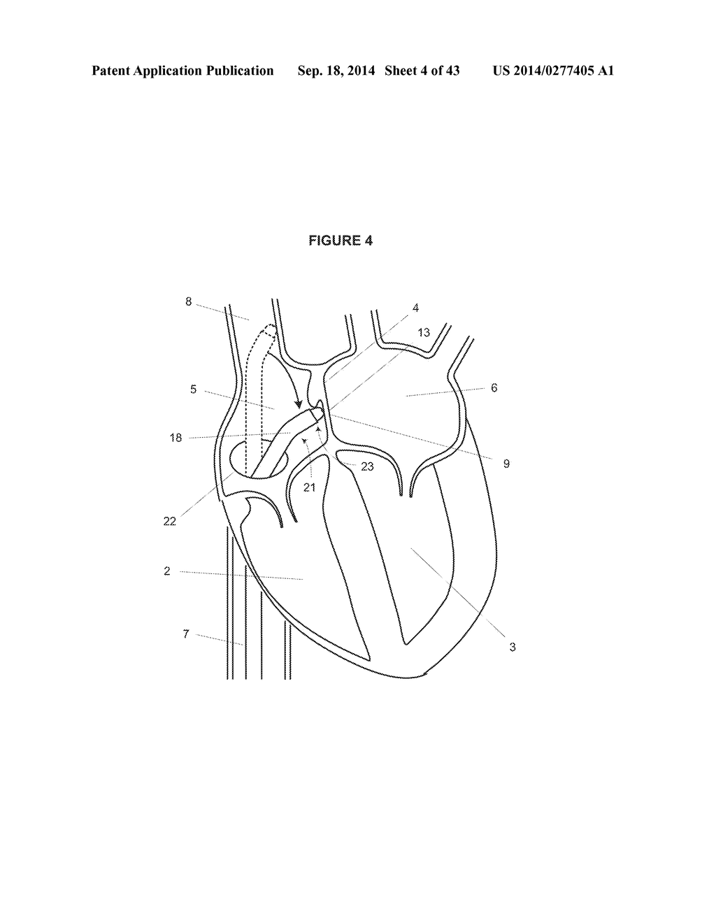 MITRAL VALVE SPACER AND SYSTEM AND METHOD FOR IMPLANTING THE SAME - diagram, schematic, and image 05